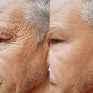 skin transformation after using retinol serum usin